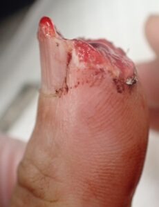 Right lateral view of a thumb with fingertip amputation caused by an electric saw, showing loss of the nail and skin, typically considered for flap surgery or stump revision.