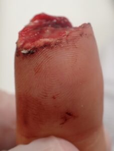 Volar view of a thumb with fingertip amputation caused by an electric saw, showing loss of the nail and skin, typically considered for flap surgery or stump revision.