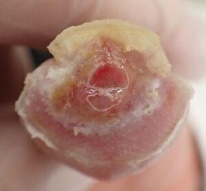 Frontal view of the thumb 23 days after fingertip amputation, showing no signs of inflammation and stable epithelialization with Natsui-style moist wound healing.