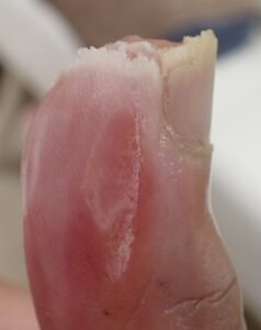 Left lateral view of the thumb 23 days after fingertip amputation, showing no signs of inflammation and stable epithelialization with Natsui-style moist wound healing.