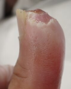Right lateral view of the thumb 23 days after fingertip amputation, showing no signs of inflammation and stable epithelialization with Natsui-style moist wound healing.