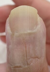 Dorsal view of the thumb 37 days after fingertip amputation, showing clear fingertip regrowth and no signs of inflammation with Natsui-style moist wound healing.