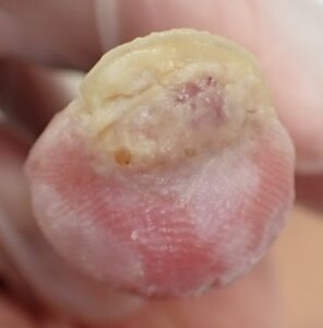 Frontal view of the thumb 37 days after fingertip amputation, showing clear fingertip regrowth and no signs of inflammation with Natsui-style moist wound healing.
