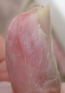 Left lateral view of the thumb 37 days after fingertip amputation, showing clear fingertip regrowth and no signs of inflammation with Natsui-style moist wound healing.