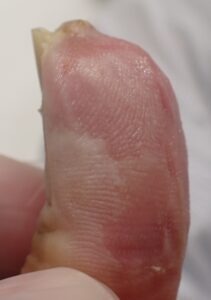 Right lateral view of the thumb 37 days after fingertip amputation, showing clear fingertip regrowth and no signs of inflammation with Natsui-style moist wound healing.
