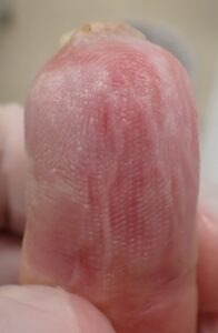 Volar view of the thumb 37 days after fingertip amputation, showing clear fingertip regrowth and no signs of inflammation with Natsui-style moist wound healing.