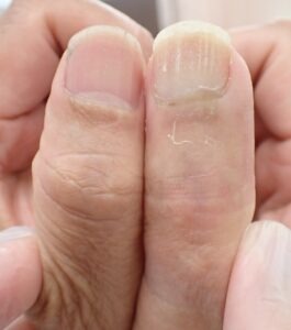 Bilateral thumb comparison 52 days after fingertip amputation, with the right thumb as the injured side, showing minimal difference using Natsui-style moist wound healing.