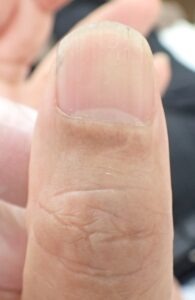 Dorsal view of the thumb 52 days after fingertip amputation, showing near-complete healing with no pain or inflammation using Natsui-style moist wound healing.
