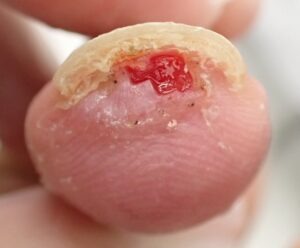 Frontal view of the thumb 52 days after fingertip amputation, showing near-complete healing with no pain or inflammation using Natsui-style moist wound healing.