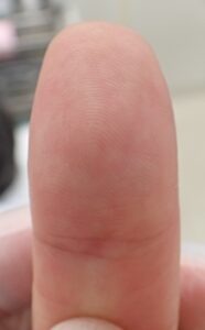 Volar view of the thumb 52 days after fingertip amputation, showing near-complete healing of the fingertip pulp with no pain using Natsui-style moist wound healing.