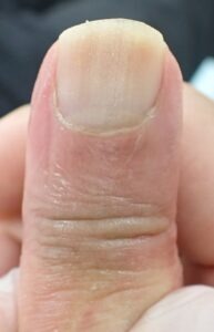 Dorsal view of the thumb 63 days after fingertip amputation, showing minimal side-to-side difference and no pain using Natsui-style moist wound healing.
