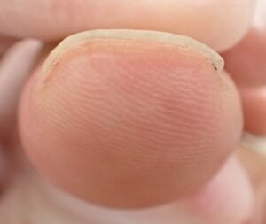 Frontal view of the thumb 63 days after fingertip amputation, showing minimal side-to-side difference and no pain using Natsui-style moist wound healing.