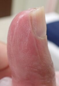 Left lateral view of the thumb 63 days after fingertip amputation, showing minimal side-to-side difference and no pain using Natsui-style moist wound healing.