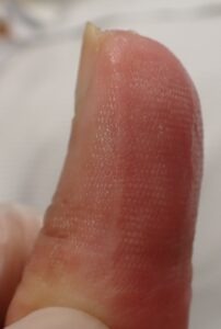 Right lateral view of the thumb 63 days after fingertip amputation, showing minimal side-to-side difference and no pain using Natsui-style moist wound healing.