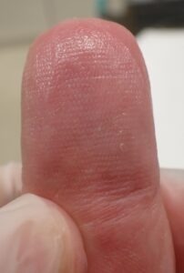 Volar view of the thumb 63 days after fingertip amputation, showing complete healing of the fingertip pulp with no pain using Natsui-style moist wound healing.