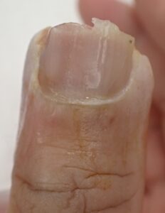Dorsal view of the thumb 9 days after fingertip amputation, showing early epithelialization and rounding of the fingertip under Natsui-style moist wound healing.