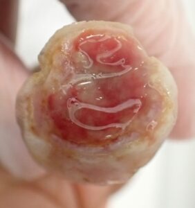 Frontal view of the thumb 9 days after fingertip amputation, showing epithelialization and early rounding with Natsui-style moist wound healing.