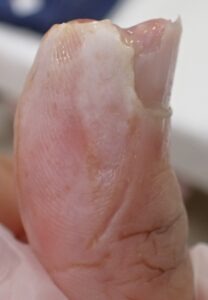 Left lateral view of the thumb 9 days after fingertip amputation, showing early epithelialization and rounding of the fingertip with Natsui-style moist wound healing.