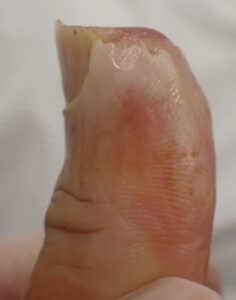 Right lateral view of the thumb 9 days after fingertip amputation, showing early epithelialization and rounding with Natsui-style moist wound healing.