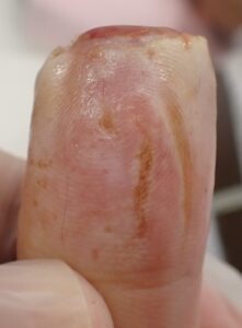 Volar view of the thumb 9 days after fingertip amputation, showing epithelialization and early rounding with Natsui-style moist wound healing.