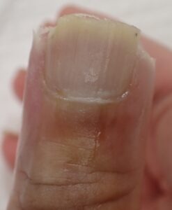 電動のこぎりによる指先切断後23日目の拇指背側所見。なつい式湿潤療法により炎症所見は消失し、上皮化が進行している状態。