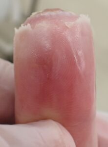 電動のこぎりによる指先切断後23日目の拇指掌側所見。なつい式湿潤療法により炎症所見は認められず、上皮化が安定して進行している状態。