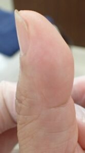 電動のこぎりによる指先切断後52日目の拇指右側面所見。なつい式湿潤療法により指先はほぼ治癒し、疼痛や炎症所見は認められない状態。