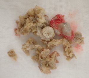 くりぬき法による粉瘤手術で摘出された粉瘤（アテローム）。内容物と被膜（嚢胞壁）が確認できる。