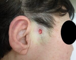 顔の粉瘤（アテローム）をくりぬき法で摘出した直後の創部。出血はほとんど認められない。