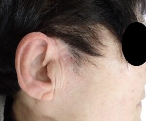 顔の粉瘤（アテローム）をくりぬき法で摘出した術後15日目の状態。なつい式湿潤療法により良好に治癒している。