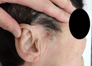 顔の粉瘤（アテローム）をくりぬき法で摘出した術後8日目の創部。痛み、腫れ、出血は認められない。