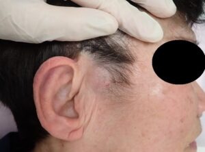 顔にできた粉瘤（アテローム）の術前写真。くりぬき法による粉瘤摘出手術を行う前の状態。