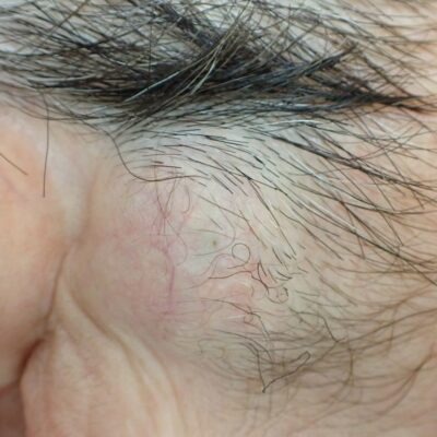 顔にできた粉瘤（アテローム）の術前写真。くりぬき法による粉瘤摘出手術を行う前の状態。