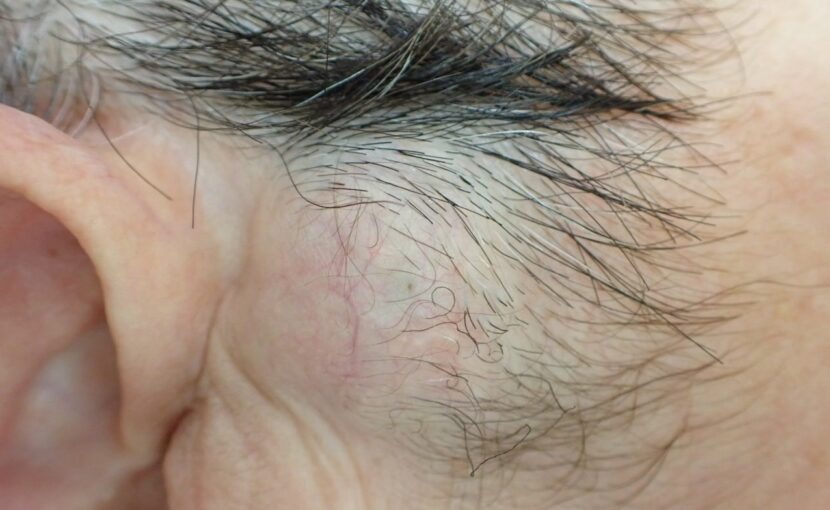 顔にできた粉瘤（アテローム）の術前写真。くりぬき法による粉瘤摘出手術を行う前の状態。