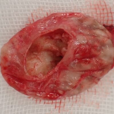 首（後頚部）の粉瘤（アテローム）被膜アップ 嚢胞壁