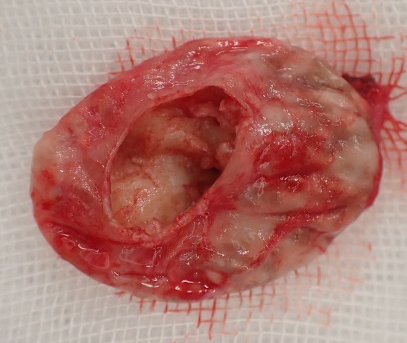 首（後頚部）の粉瘤（アテローム）被膜アップ 嚢胞壁