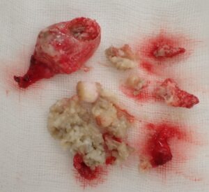 首（後頚部）の粉瘤（アテローム）摘出標本 被膜と内容物