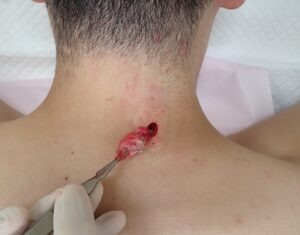 首（後頚部）の粉瘤（アテローム）術中写真 被膜摘出