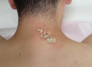首（後頚部）の粉瘤（アテローム）術中写真 内容物排出