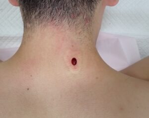 首（後頚部）の粉瘤（アテローム）術直後写真 くりぬき法 小さな創部