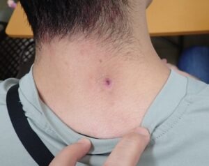 首（後頚部）の粉瘤（アテローム）術後15日 創部縮小 無症状