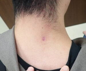 首（後頚部）の粉瘤（アテローム）術後22日 治癒 創部良好