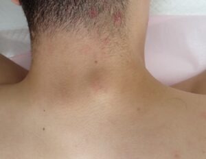 首（後頚部）の粉瘤（アテローム）術前写真 皮下しこり