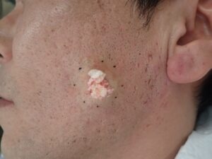 頬部の粉瘤をくりぬき法で摘出中の写真。小さな穴から粥状の内容物が排出されている様子。大阪・新大阪のクリニックでの日帰り手術。