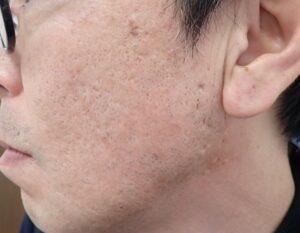 頬部の粉瘤をくりぬき法で手術して7年後の写真。傷跡がほとんど分からない状態。大阪・新大阪のクリニックでの日帰り手術の長期経過。