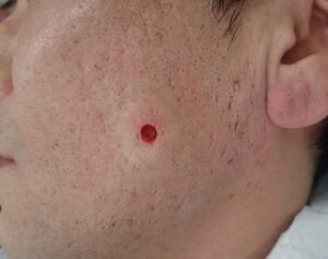 頬部の粉瘤をくりぬき法で摘出した術直後の写真。創部は数ミリと小さい状態。大阪・新大阪のクリニックでの日帰り手術。