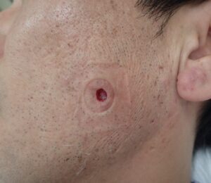 頬部の粉瘤をくりぬき法で摘出した術後1日目の写真。創部は数ミリと小さい状態。大阪・新大阪のクリニックでの日帰り手術後の経過。