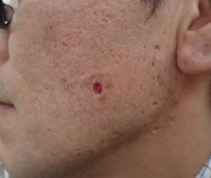 頬部の粉瘤をくりぬき法で摘出した術後4日目の写真。創部がさらに小さく縮小した状態。大阪・新大阪のクリニックでの日帰り手術後の経過。