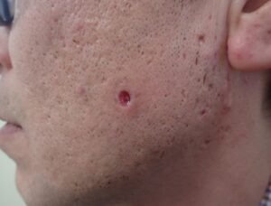 頬部の粉瘤をくりぬき法で摘出した術後7日目の写真。創部がほぼ閉鎖し小さな点状になった状態。大阪・新大阪のクリニックでの日帰り手術後の経過。