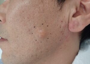 左頬にできた粉瘤の術前写真。約1年前から出現し最近増大した頬部の出来物。大阪・新大阪のクリニックでくりぬき法・なつい式湿潤療法による日帰り手術前の状態。